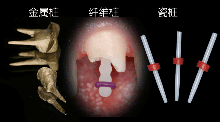 作者:谭建国教授临床上对于大面积牙体缺损牙齿的修复中如何选择桩?