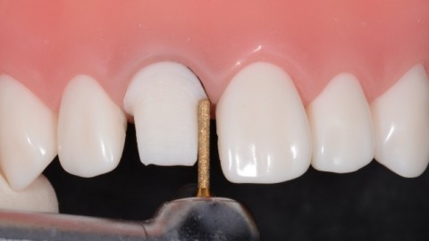 一步一步做好前牙全瓷冠牙体预备- 齿美科技- 专注牙齿美学修复,打造高