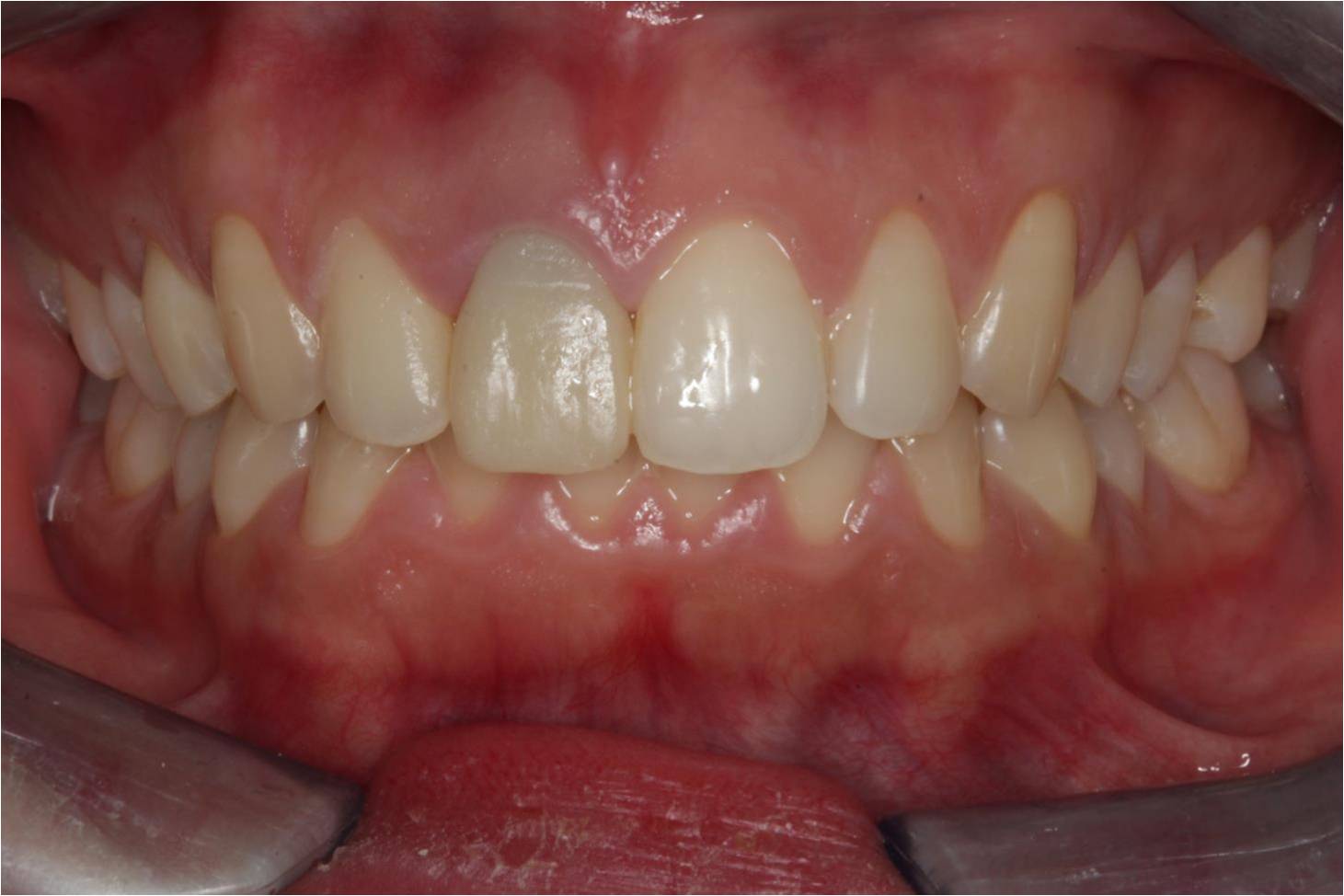 聚合瓷遮色铸造桩在前牙美学修复中应用 1 例