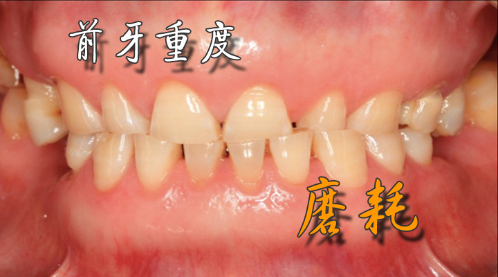 牙齿美学修复理论与实践学习班--前牙重度磨耗的美学和功能重建